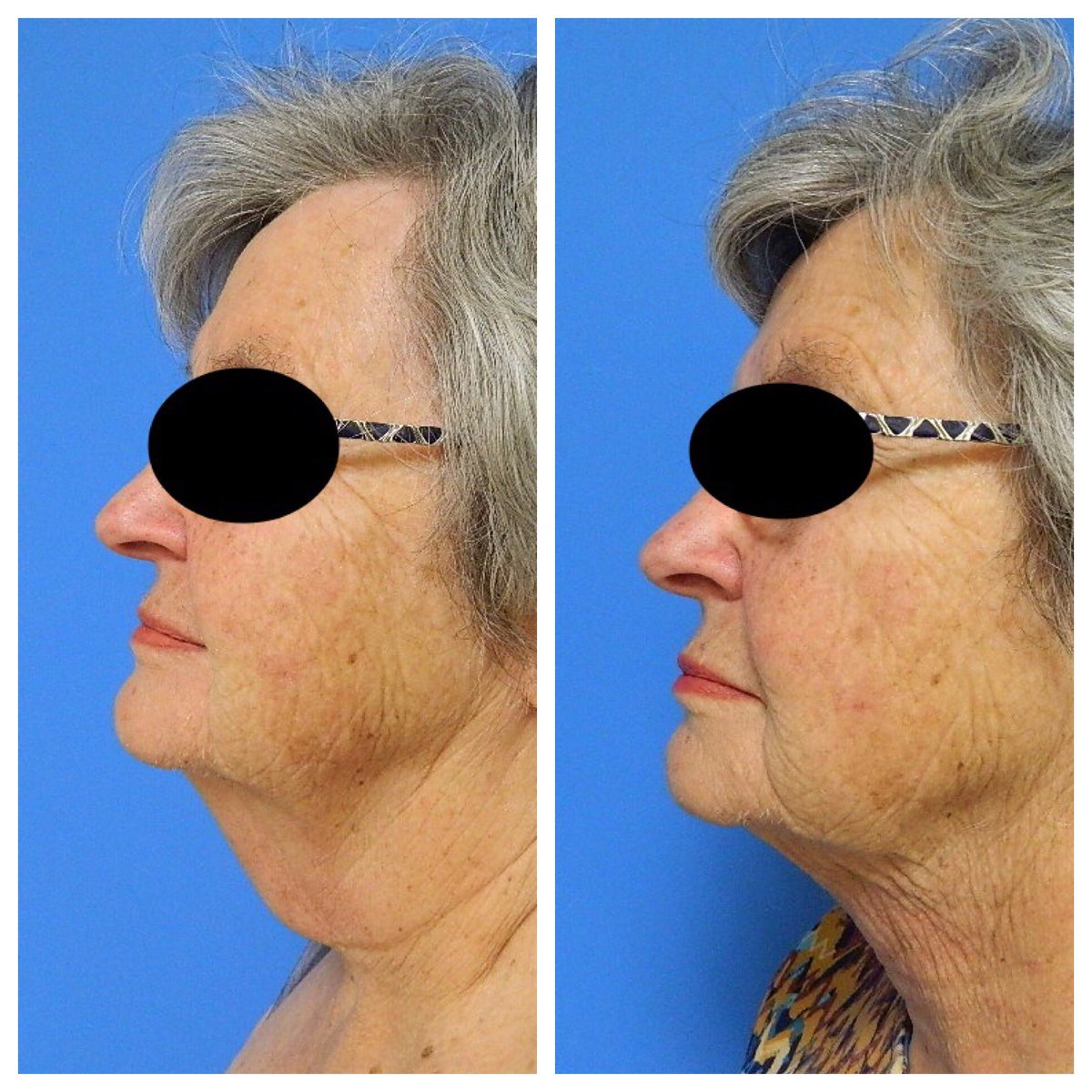 prsofcc's tweet photo. Look younger with the Precision Tx neck lift performed in about an hour in the office. #precisiontx #necklift #officeprocedure #transformationtuesday #lookyounger #antiaging https://t.co/FP9b1rYr50