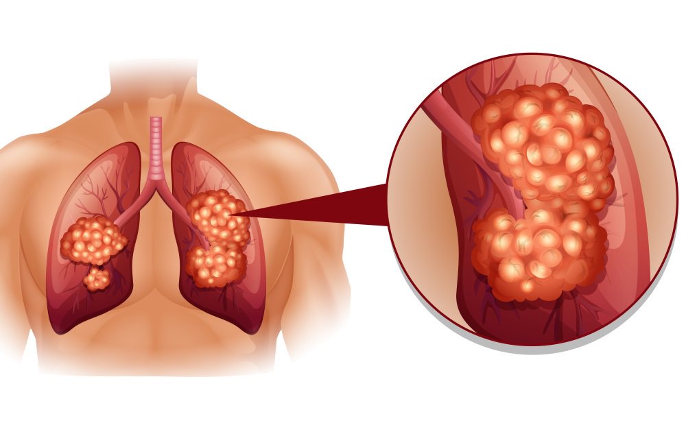 Jamie_Catlett's tweet photo. 8 Surprising Signs Of Lung Cancer You Should Know https://t.co/zFW7wriIii https://t.co/FWPF1HCDFq