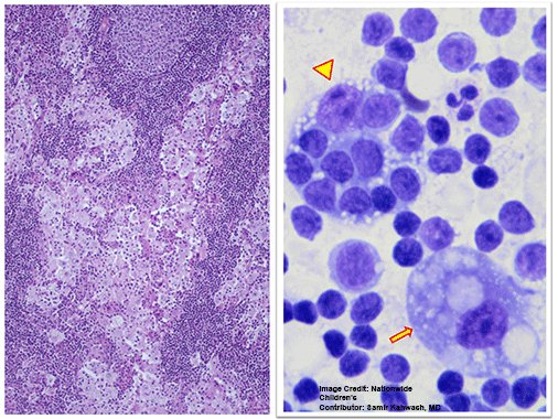 NCHforDocs's tweet image. Representative H&amp;amp;E stained section and Giemsa stained touch imprints of a lymph node excised from this 6-year-old boy with massive cervical lymphadenopathy - What is your diagnosis? #NCHPath #PediPath #NCH_COTW