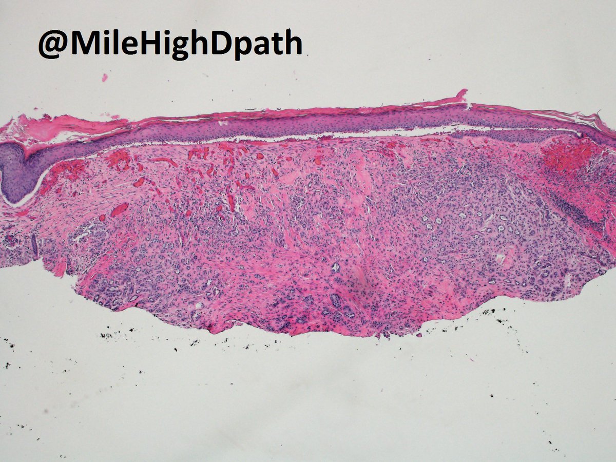 MileHighDpath's tweet photo. FOLLOW UP TWEET - Recommended re-biopsy arrived -  indeed it is ductal (as suspected based upon uber-thin first shave).  CK7 pos. P63 neg.  Pt w/ h/o of breast bx times 3 of same lesion at OSH w/o firm carcinomatous dx rendered.  What does this do for you so far? #luckythangood https://t.co/edJ2JUbAqY