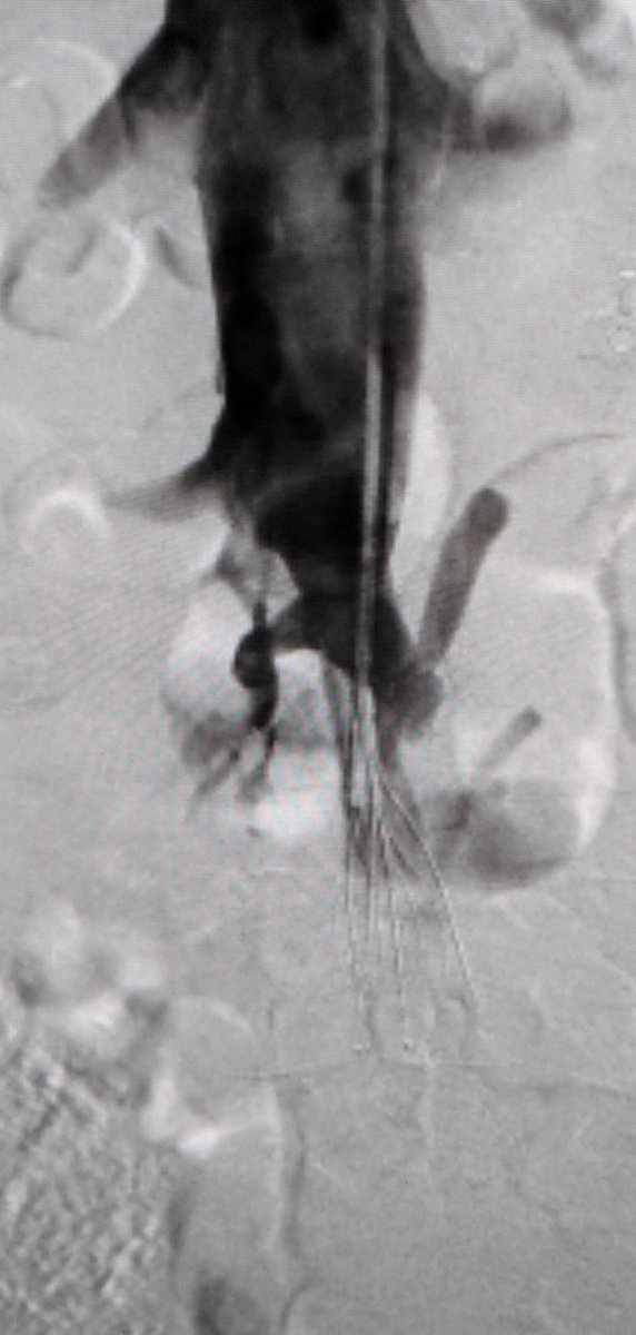 LessneVIR's tweet photo. Once there was a #filter without an IVC...
Severe, chronic pop to IVC occlusion. Back end of glide to cross IVC. PTA inflow &amp; #CDT(a la Access PTS). Then #filterOUT (of course) &amp; rebuild! Inflow &amp; outflow dz always a challenge. 🤞 @CLTRadiology #IRad @Dr_Sudi @rkryu https://t.co/76LjIUxmtt