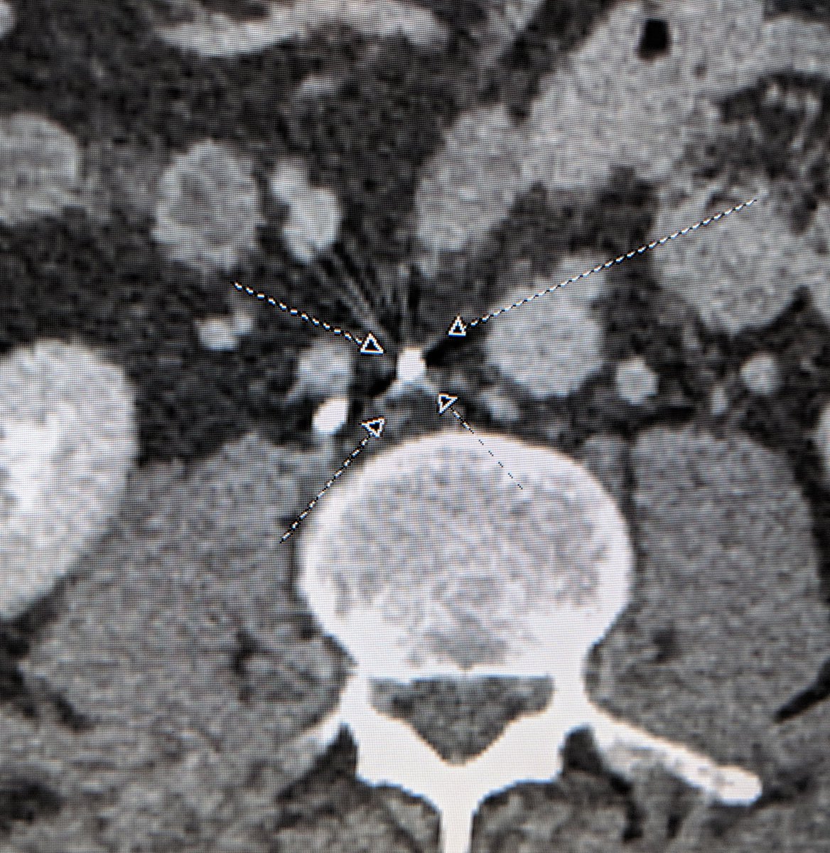 LessneVIR's tweet photo. Once there was a #filter without an IVC...
Severe, chronic pop to IVC occlusion. Back end of glide to cross IVC. PTA inflow &amp; #CDT(a la Access PTS). Then #filterOUT (of course) &amp; rebuild! Inflow &amp; outflow dz always a challenge. 🤞 @CLTRadiology #IRad @Dr_Sudi @rkryu https://t.co/76LjIUxmtt