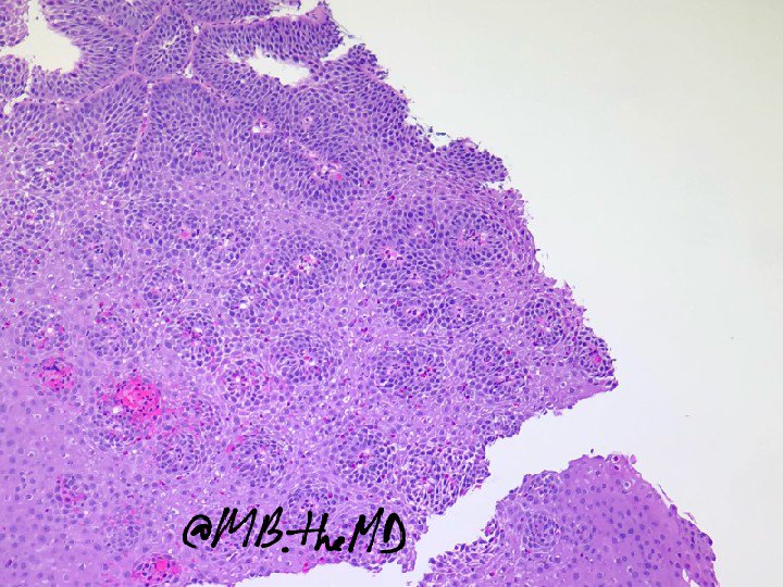 MB_thepathMD's tweet photo. #pathart #esophagus #gipath #pathcases https://t.co/G38dXYkU81