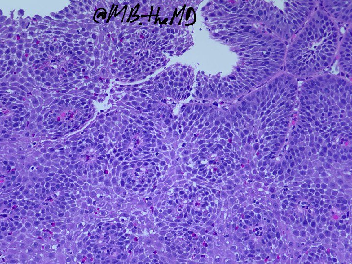 MB_thepathMD's tweet photo. #pathart #esophagus #gipath #pathcases https://t.co/G38dXYkU81