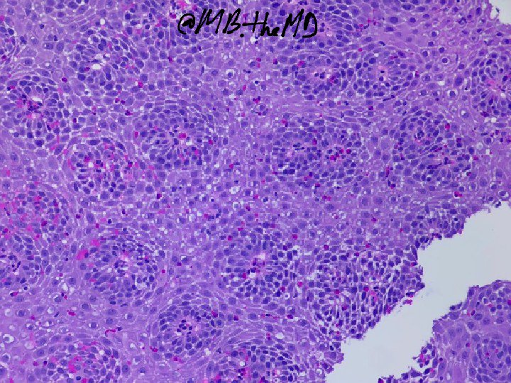 MB_thepathMD's tweet photo. #pathart #esophagus #gipath #pathcases https://t.co/G38dXYkU81