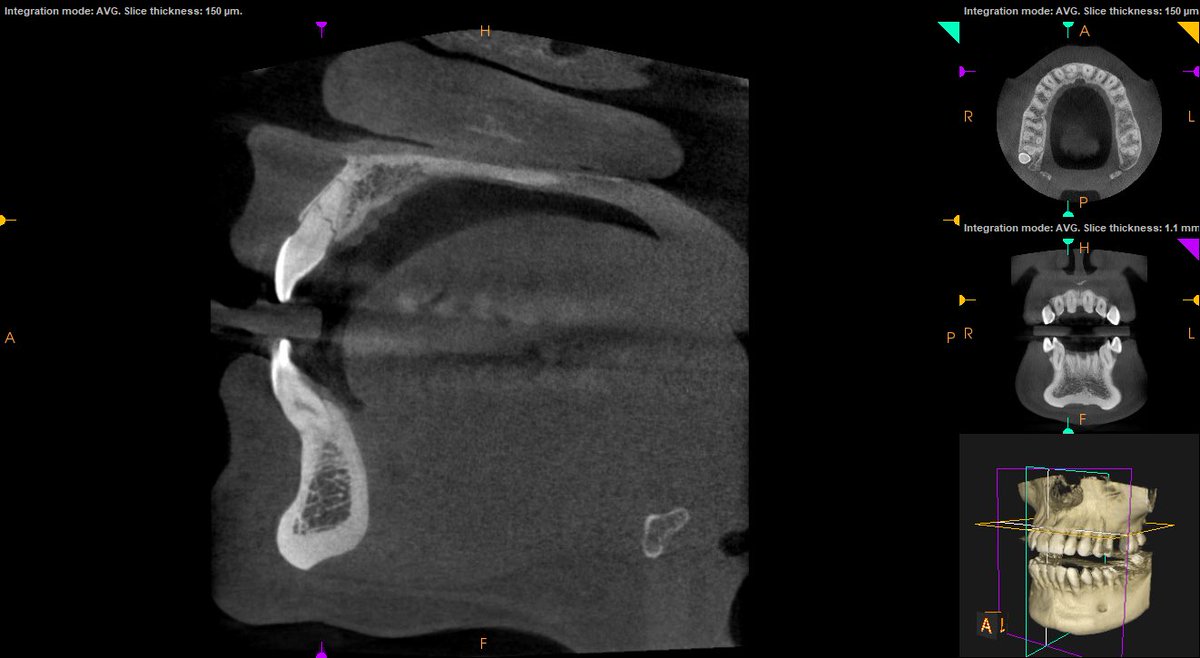 DigitalJamesDD's tweet photo. Interested in 3D these images are from the @CarestreamDentl #CS8100 #3D unit giving you excellent images can you spot the fracture. Available from @THE_DD_UK call us today to discuss you #digital #dentistry requirements. #CBCT #future #Standout #wedomore #theDDdifference https://t.co/Bn4zHugl0I
