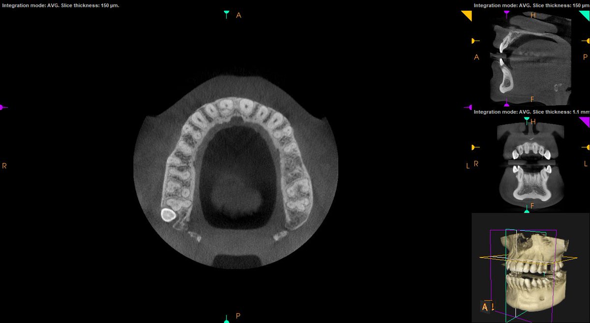 DigitalJamesDD's tweet photo. Interested in 3D these images are from the @CarestreamDentl #CS8100 #3D unit giving you excellent images can you spot the fracture. Available from @THE_DD_UK call us today to discuss you #digital #dentistry requirements. #CBCT #future #Standout #wedomore #theDDdifference https://t.co/Bn4zHugl0I