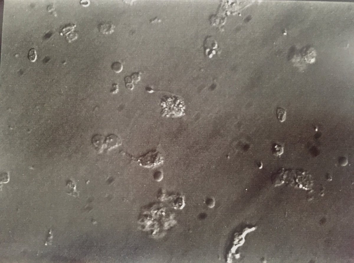 AranGalanR's tweet photo. ICSI con biopsia testicular, para encontrar estos 4 he estado media hora... menos mal que me han ayudado! #icsia6manos #3microscopiosalavez #icsidifícil #compismajas https://t.co/T3OsHCJ3uy