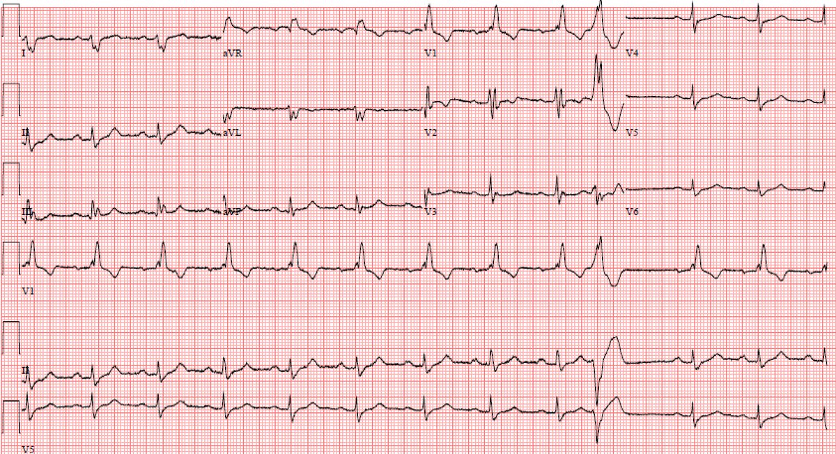 Interesting case of syncope. ECG shows RBBB, LPFB, and a prolonged PR, consistent with an incomplete trifascicular block. Can lead to intermittent or complete HB. Admitted for EP study -- left with a pacemaker. @OSUEMEdu