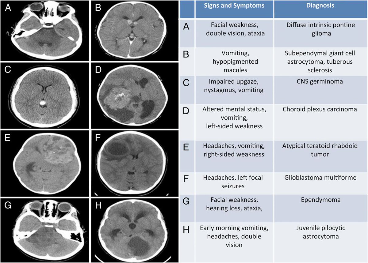 #pediatriccare #cancerresearch #Immunotherapy Dual targeting of #mitochondrialfunction & #PI3K / #AKT/ #mTORpathway with #mTORinhibitor #temsirolimus for #diffuseintrinsicpontineglioma #Childhoodbraincancer buff.ly/2us1jQZ @OncotargetJrnl