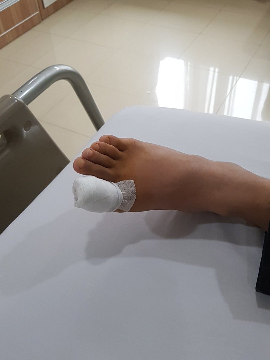 RMersyah's tweet photo. Operasi kecil ibu jari kaki... https://t.co/GhbiuSwxqQ