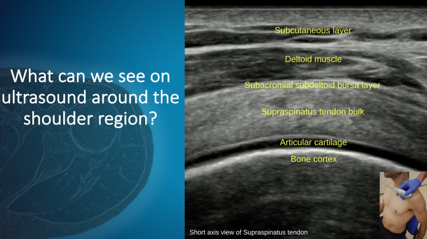 mskultrasound's tweet image. Looking forward and honoured to be presenting at the Danish Physiotherapy Conference in April. A complex and challenging area of clinical practice currently,critical evaluation and a balanced approach important. #holistic #patientcentred #keepitrelevant
