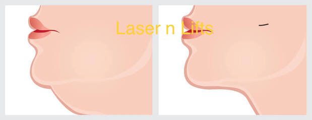 HairMultan's tweet image. Treatment for double chin, body sculpting !