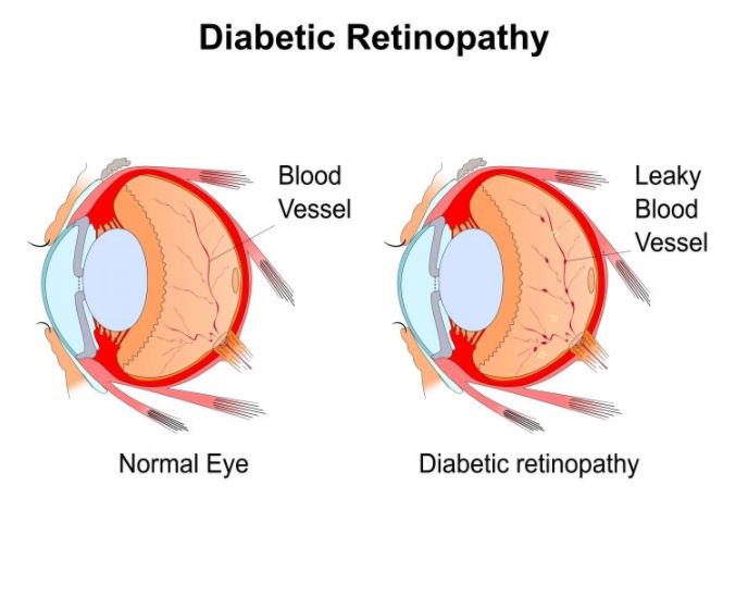 Uncontrolled diabetes may affect various organs, including your eyes. Learn what diabetic retinopathy is here. bit.ly/2tSrbVG