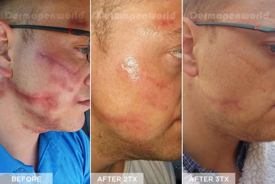 ivanmedgroup's tweet photo. Scars like these often thicken over time and treatments have been historically limited. @DermapenWorld's unique vertical stamping and depth control, up to 2.5mm, helps alleviate the appearance of #scarring and can be a better modality to other methods or rollering https://t.co/pw532kKmlH