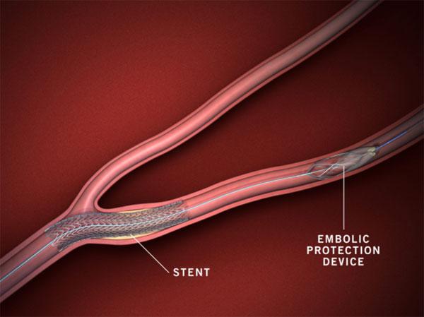 CRMjournal's tweet photo. Recently accepted: #Safety and #efficacy of #CerebralProtectionDevices (#CPD) in #TranscatheterAorticValveReplacement (#TAVR): A #ClinicalEndpoints #MetaAnalysis by @DMohananey https://t.co/t2SgBtewal https://t.co/jgc3S4MjOC