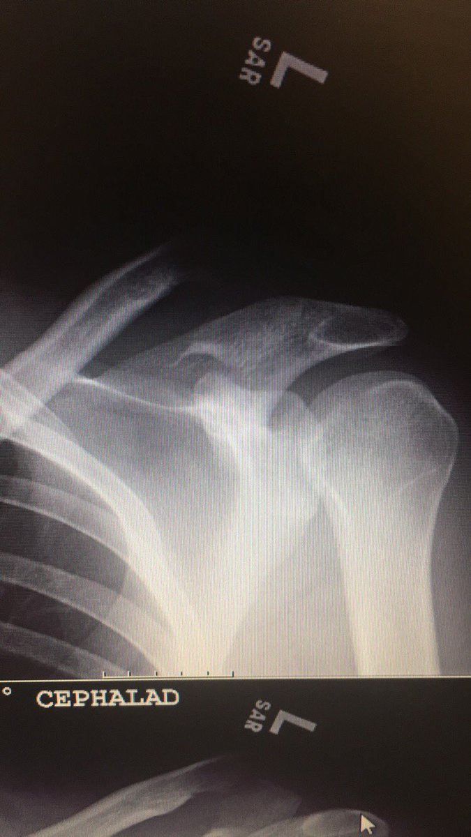 markthenative's tweet photo. This is what I got to get put in, then in 4 months taken out. Ugh. #hookplate https://t.co/goibOd8YCp
