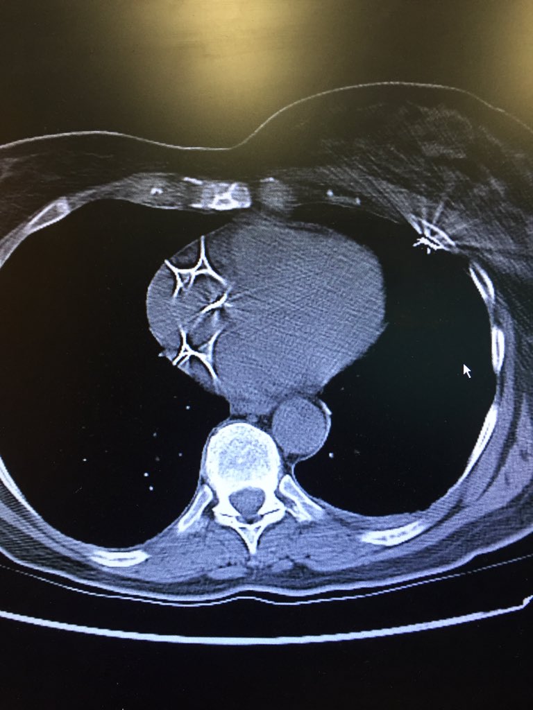 EPatPitt's tweet photo. @aalahmadmd @jelevenson @PittCardiology  @AndrewVoigtMD @KBerlacher CT here. via @KrishKancharla https://t.co/x4GnyDXTkd