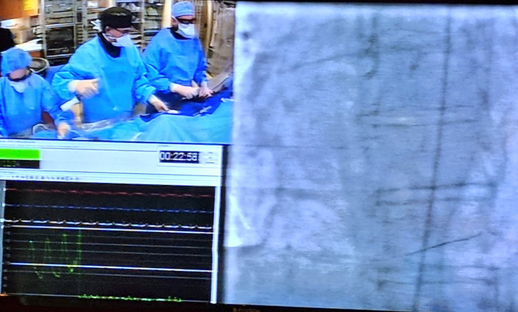 PerwaizMeraj's tweet photo. Rajesh Dave demonstrating live case orbital #atherectomy #ivus #LM stenting using #cobra #PzF stents at #PakLive in high bleeding risk patient. https://t.co/zv1WUCDlWV