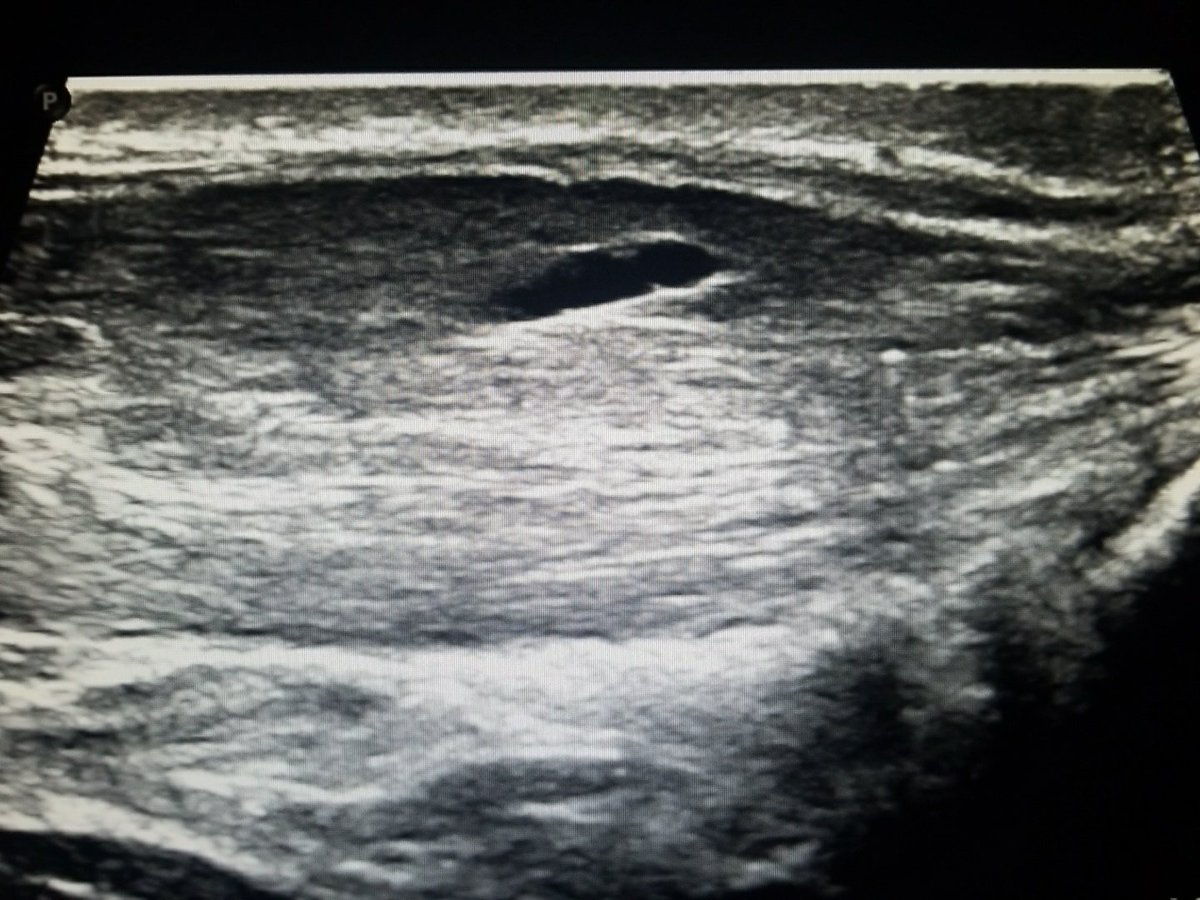 Achilles thickness >1cm and intrasubstance clefts indicate severe tendinosis and superimposed interstitial tears. Ouch!
#MSKUS