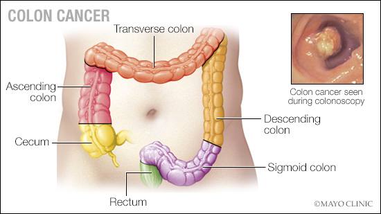 mayo clinic on twitter having a colonoscopy to check for colon