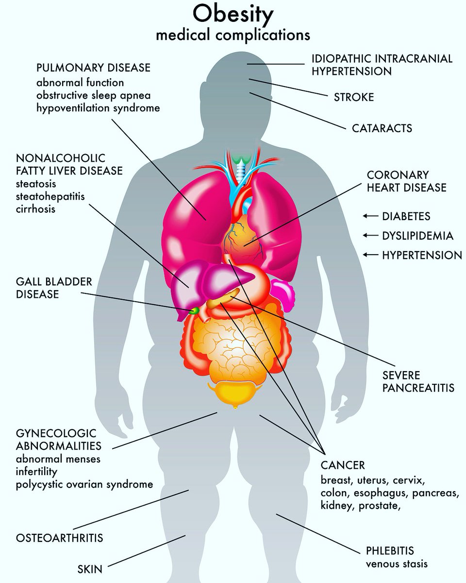 ThinkHealthyFit's tweet image. Obesity's Medical Complications
.
.
Follow: @ThinkHealthyFit for more
.
.
#health #healthy #obesity #breastcancer #bladder #cancer #complications #pulmonaryhypertension #liverdisease #infertility #polycysticovariansyndrome #osteoarthritis