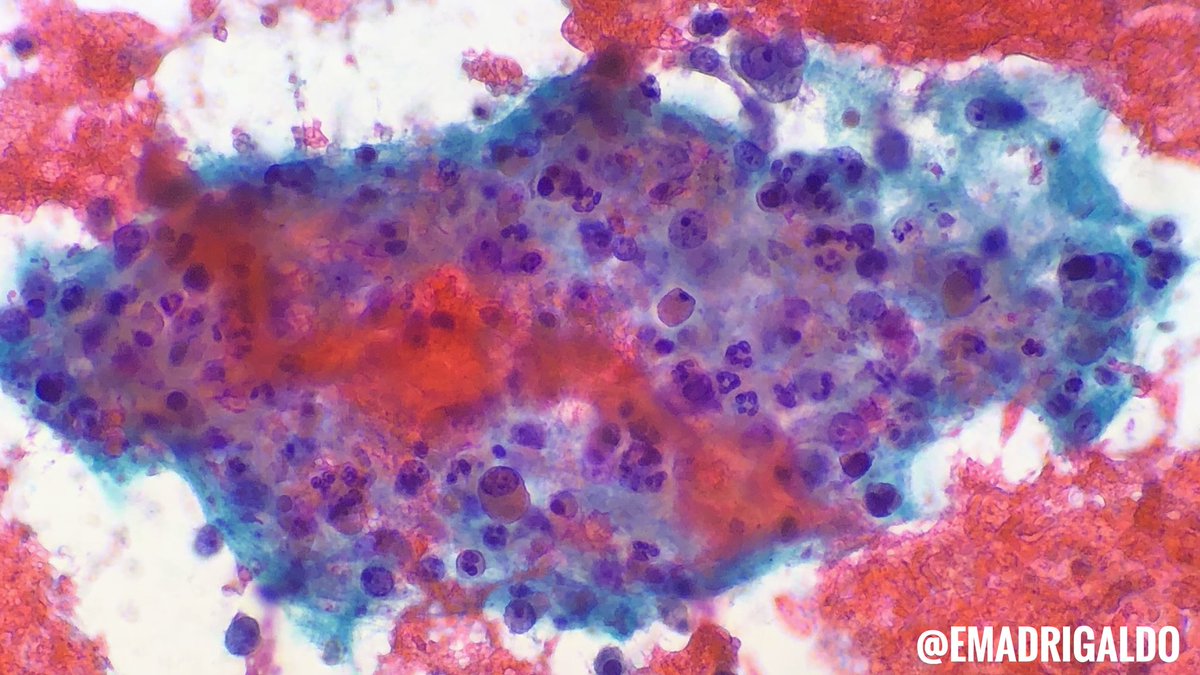 EMadrigalDO's tweet photo. 11 cm #adrenal mass showing CORTICAL CARCINOMA #FNAfriday

Pleomorphic nuclei, nucleoli, mites, vacuolated/eosinophilic cytoplasm; inhibin+, melanA+, synapto+

DDx: 
1) Adenoma: <5cm, lacks mites, necrosis
2) RCC: melanA(-), inhibin(-)
3) Pheo: chromo+, melanA(-), inhibin(-) https://t.co/G1P4HVvOJV