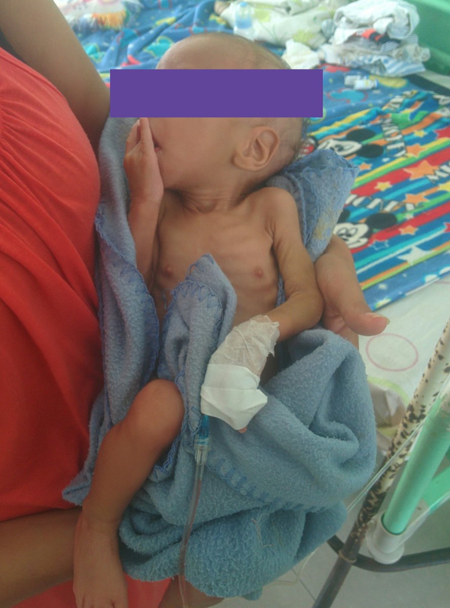 IndiraRausseo's tweet photo. #30Mar / #AyudaAUnBebé / Él se llama Alfonso (4 meses) 💙. Le recomendaron alternar la leche de fórmula con cremitas de vegetales para que su organismo reciba más nutrientes. Necesita #ceftriaxona y pañales para recién nacidos. #Maturin https://t.co/m19jrQoD9g