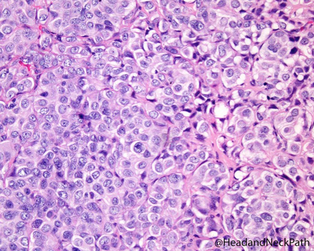 HeadandNeckPath's tweet photo. A focus on neuroendocrine tumors of the larynx presented by Dr. Perez-Ordoñez at NASHNP companion meeting: https://t.co/CiIEZwA3Dk
#HeadNeckPathol #HNPJ #HeadandNeckPath #Pathology #ENTPath #PathologyTweet #NASHNP https://t.co/pa9AxaWZre