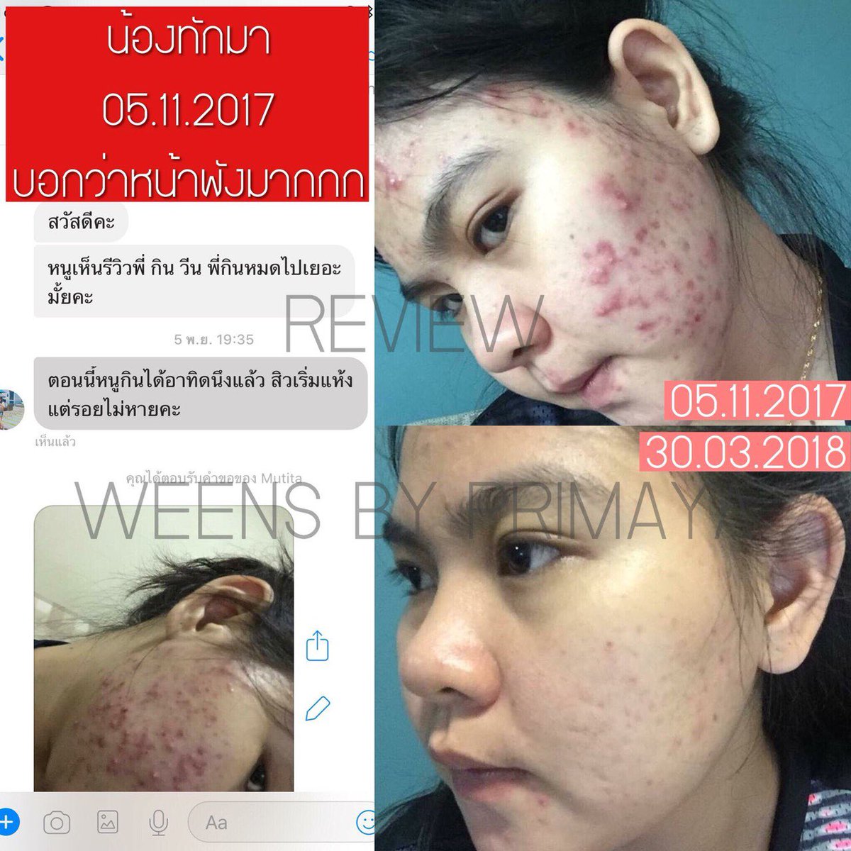 Primayaaaa's tweet image. น้องคนนี้ กินวีนส์ไป 7 กล่อง ทาน 4เดือน 
ผลออกมาอย่างที่เห็นนาจา 😍😍
แอดจะไม่พูดเยอะ🤫ของดีไม่ต้องพูดไรเยอะเล๊ยยย 😉💙💁🏼‍♀️

📲 👉🏻  bit.ly/2sEcvJd 
#Primaya #ลดน้ำหนัก #หุ่นสวย #howtoperfect #howtobeauty #ฉันจะผอม #ถูกและดีบอกต่อ #ของดีบอกต่อ