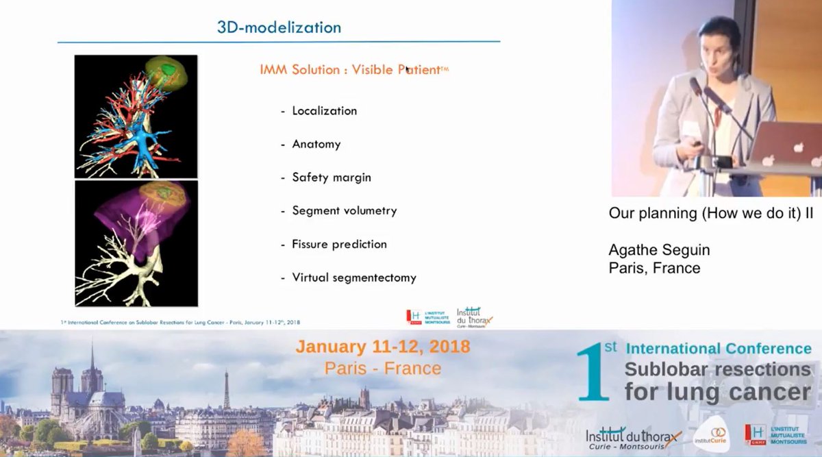 Visible Patient assists Thoracic Surgeons for sublobar resection. Discover it in several talks of Prof. Gossot, Prof. Baste, Dr. Seguin-Givelet, Dr. Grigoroiu during the 1rst International Conference on Sublobar Resections for Lung Cancer : lnkd.in/gqSd33H