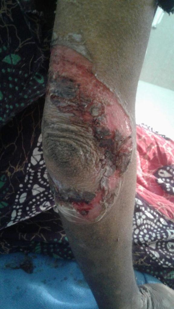 GouravSawhney2's tweet photo. Wah re J&amp;K Sarkar, Specially Hamare Health Minister Sahab,SMGS Hospital mein Skin Patient ki buri halat hai na toh unke liye medicines hai aur na hi skin patient ke liye itni garmi mein cooler(AC toh inke bas ka nahi hai) intzaam nahi hai,Mein is patient ka face nahi dikha Sakta https://t.co/H2c81iG3FT