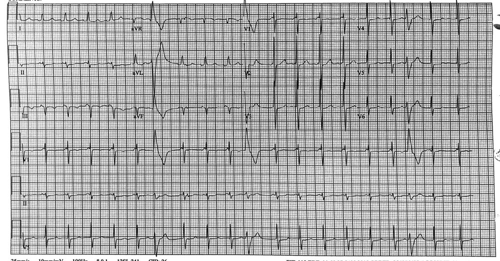 AndrewVoigtMD's tweet photo. Hospitalized pt with recurrent palpitations. Baseline, rhythm strip of initiation, and 12 lead in tachycardia shown. Thoughts on mechanism? #SVT #shortPR @narrowQRS @Dr_Santangeli @sgreenbergmd @KrishKancharla @PittCardiology @EPatPitt https://t.co/KmYkyBwjPi