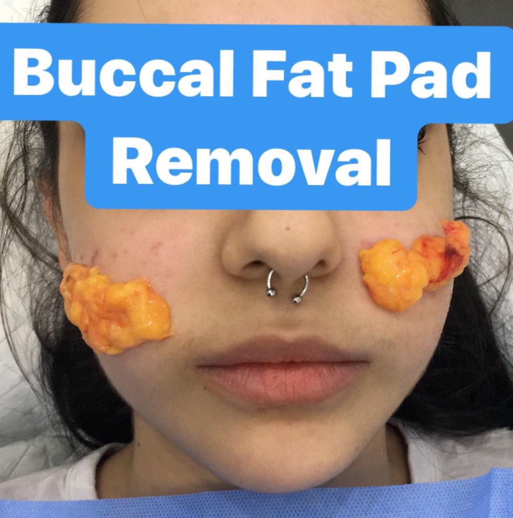 Dr. Nabil Fakih on X: What is Buccal Fat Pad Removal? Slim your face by  Buccal fat pad removal. By removing the Buccal fat pad your cheeks will be  more prominent and