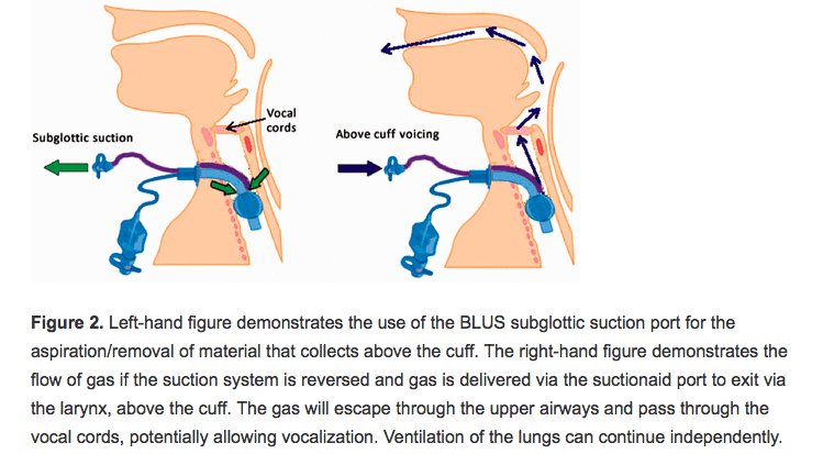 Online first: Safety and feasibility of above cuff vocalisation for ventilator dependent patients with tracheostomies journals.sagepub.com/doi/full/10.11… #foamed #foamcc
