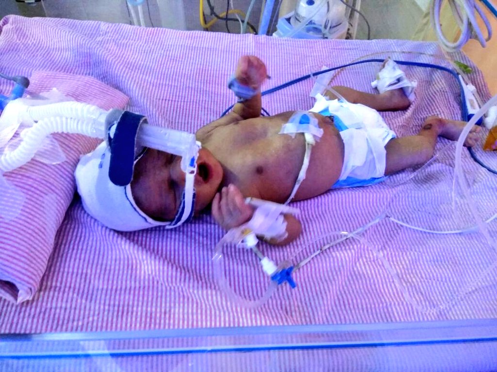UV_Prabhas's tweet photo. @KTRTRS sir please help 🙏🙏this baby boy is suffering with #Breathing_problem since the time of birth itself. it's hardly 13days still in the ICU ventilator. Per day they spent around 19K/Rs.Overall amount is nearly 3lakhs.He is from poor family can't afford it
Ph: 8985280167. https://t.co/PYCukQ59BR