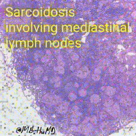 ··Fungal and AFB stains are negative, cultures also negative and the widespread distribution of granulomas supports the dx·· #pathology #pathclues #pathcases #pathart #pathresident #pulmpath #lungpath