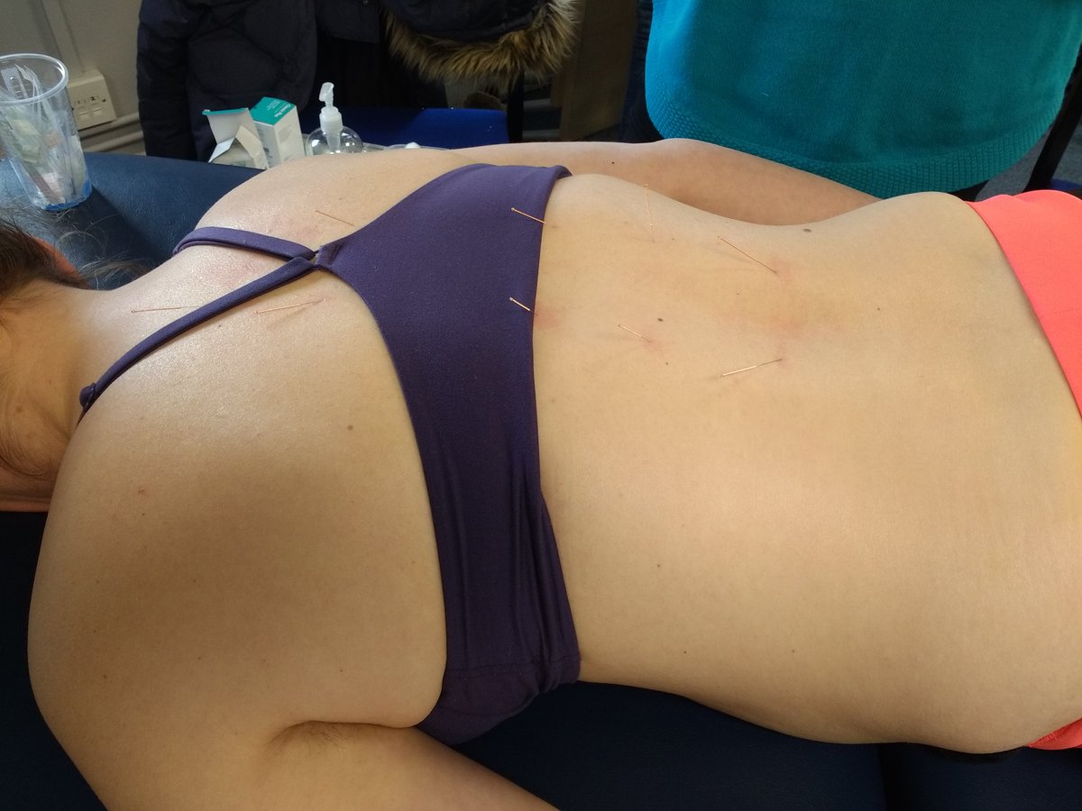 Many thanks to Lynn Pearce and <a href="/AACP_Physio/">AACP</a> for the informative &amp; enjoyable 'Effecting the affect' course. My acupoint selection will now have more consideration of the person's limbic system state. Below is a 'holding pattern' often used as a starting point with strong emotions