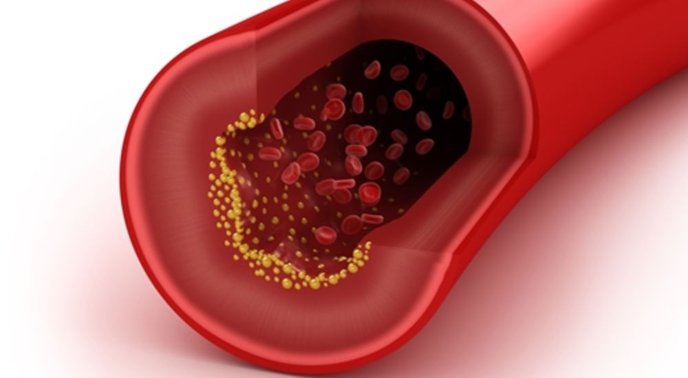 KFSHRC_Research's tweet image. #Thromboembolic Risk in Patients With Atrial Fibrillation After Coronary Artery Bypass Graft Surgery
bit.ly/2J3FFWc