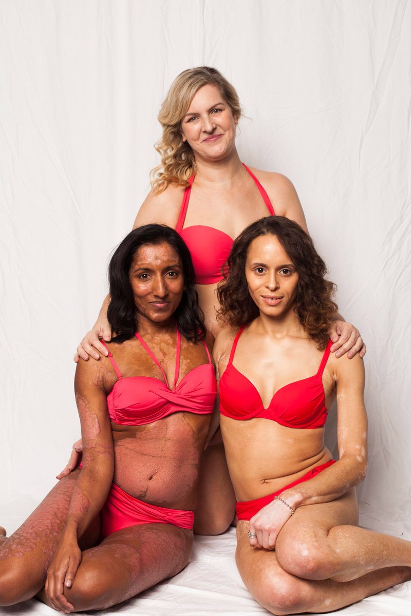 Love Disfigure (@lovedisfigure) on Twitter photo Being around such beautiful positive people & wonderful photographer <a href="/sophiemayanne/">Sophie Mayanne</a> created the perfect Photoshoot. We r continually helping change peoples lives #bodyacceptance #bopo <a href="/AhilaJegerajan/">healpsoriasis</a> <a href="/Being_Just_Us/">Natalie Ambersley</a> <a href="/MakeupRVLTN/">Makeup Revolution</a> <a href="/On2Chris/">Today its Harry</a> <a href="/Swimwear365/">Swimwear365</a> #DiversityandInclusion Being around such beautiful positive people & wonderful photographer <a href="/sophiemayanne/">Sophie Mayanne</a> created the perfect Photoshoot. We r continually helping change peoples lives #bodyacceptance #bopo <a href="/AhilaJegerajan/">healpsoriasis</a> <a href="/Being_Just_Us/">Natalie Ambersley</a> <a href="/MakeupRVLTN/">Makeup Revolution</a> <a href="/On2Chris/">Today its Harry</a> <a href="/Swimwear365/">Swimwear365</a> #DiversityandInclusion