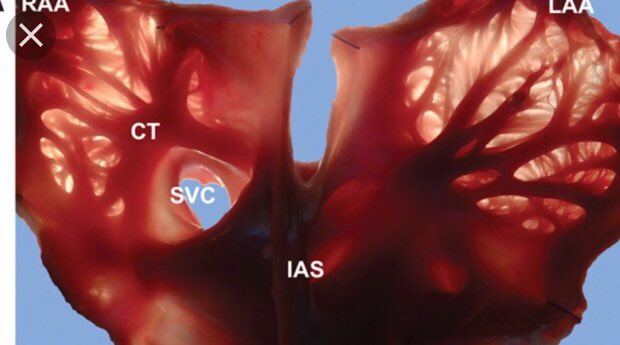 <a href="/dredcronin/">Edmond Cronin</a> @DhirajGuptaEP The same may account for the free wall/LAA:&lt;1mm wall thickness,highly trabeculated. Hard to imagine that one global voltage cut-point can identify scar here.Alternatives needed to characterize heterogeneous substrates and anatomy. <a href="/PrashSanders/">Prash Sanders</a> <a href="/nmarrouche/">Nassir Marrouche</a> doi.org/10.1161/CIRCEP…