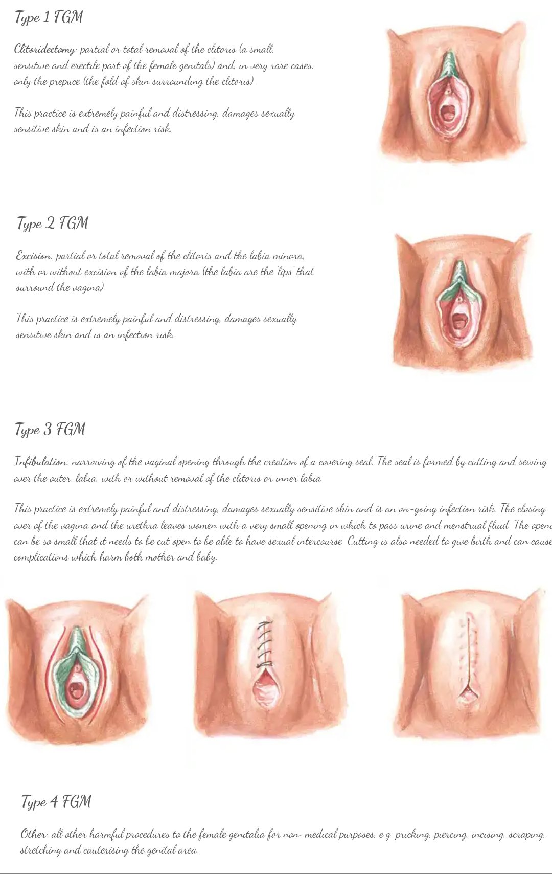 removal Clit ring