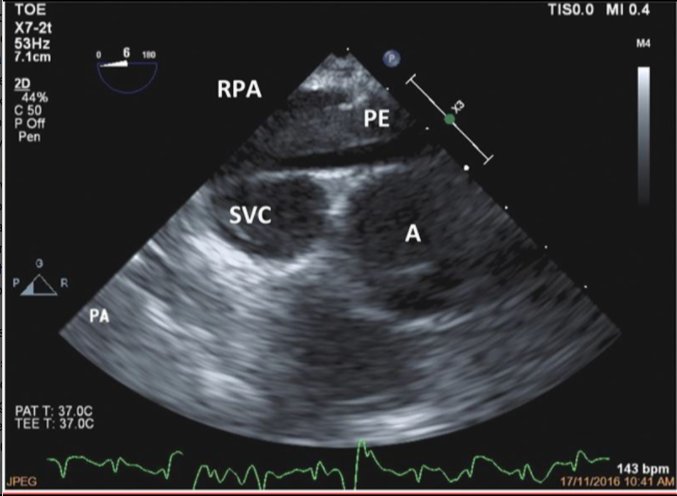 IARS_Journals's tweet photo. Open Access case report from our companion journal, A&amp;A Practice: Successful Resuscitation of Maternal Cardiac Arrest With Disseminated Intravascular Coagulation Guided by Rotational #thromboelastometry and #transesophageal #echocardiography https://t.co/xoHwh9s92v https://t.co/aUo81fDwgn