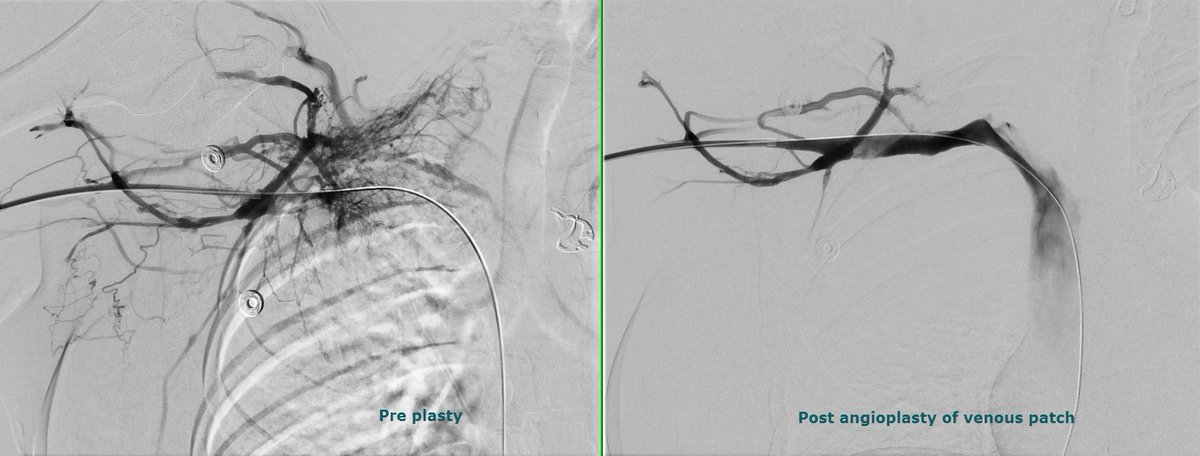 Mani NBS (@maninbsir) on Twitter photo Young #patient with #Pagetschroetter syndr- #arm swelling 1 mon s/p surg-rib resection/venous patch. #IRAD <a href="/WashUIR/">Mallinckrodt IR</a> can help treat #withoutascalpel.<a href="/SIRspecialists/">Society of Interventional Radiology</a> <a href="/SIRRFS/">SIR RFS</a> <a href="/JVIRmedia/">JVIR</a> <a href="/CVIR_Journal/">CVIR Journal</a> <a href="/Seungkim89/">Seung Kim</a> @rramaswamy <a href="/GokeIRDoc/">Goke Akinwande</a> <a href="/WashUSurgery/">WashU Medicine Department of Surgery</a> <a href="/kavaliIR/">Pavan Kavali</a> @ABrandisVIR <a href="/ajgunnmd/">AJ Gunn</a> Young #patient with #Pagetschroetter syndr- #arm swelling 1 mon s/p surg-rib resection/venous patch. #IRAD <a href="/WashUIR/">Mallinckrodt IR</a> can help treat #withoutascalpel.<a href="/SIRspecialists/">Society of Interventional Radiology</a> <a href="/SIRRFS/">SIR RFS</a> <a href="/JVIRmedia/">JVIR</a> <a href="/CVIR_Journal/">CVIR Journal</a> <a href="/Seungkim89/">Seung Kim</a> @rramaswamy <a href="/GokeIRDoc/">Goke Akinwande</a> <a href="/WashUSurgery/">WashU Medicine Department of Surgery</a> <a href="/kavaliIR/">Pavan Kavali</a> @ABrandisVIR <a href="/ajgunnmd/">AJ Gunn</a>