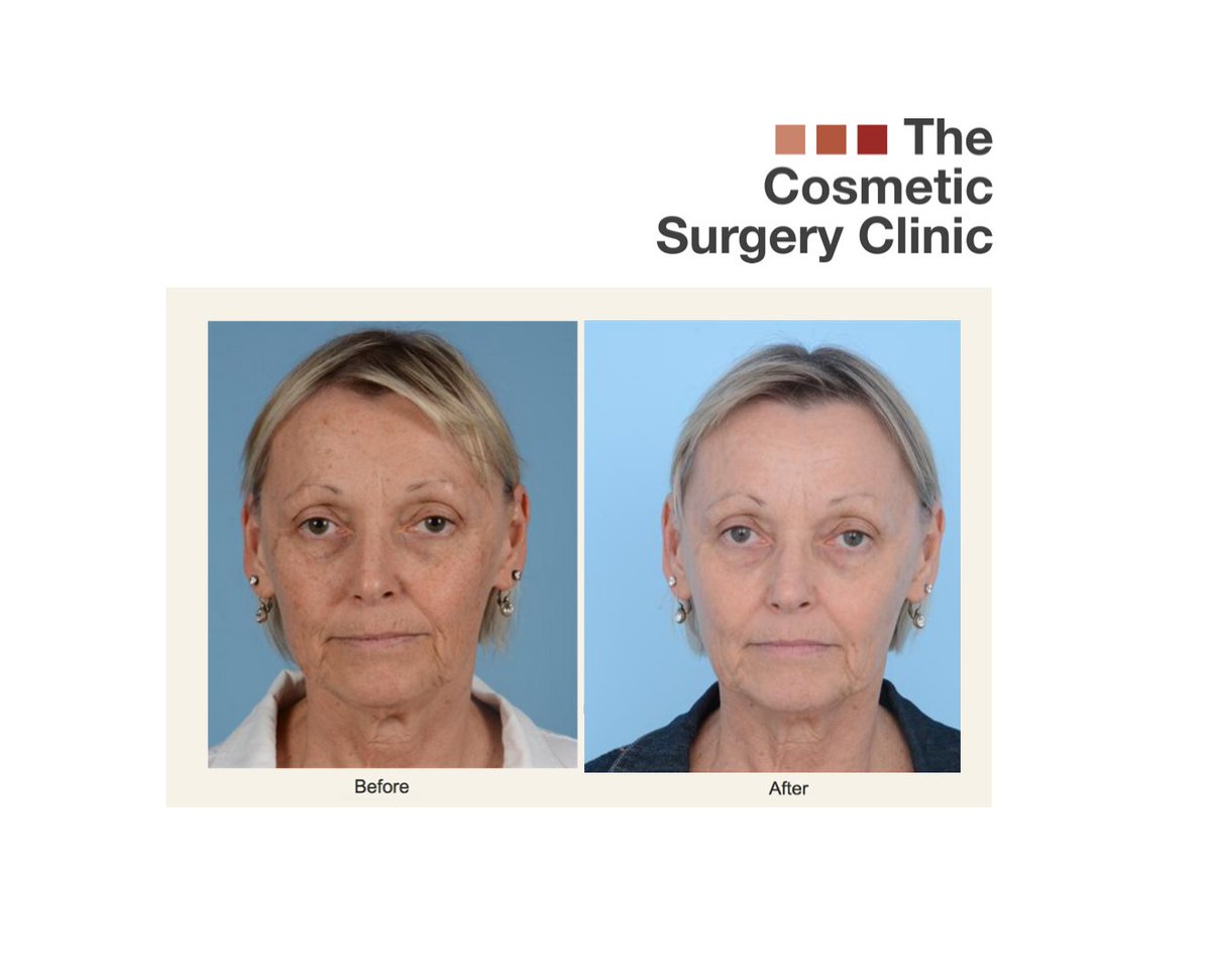 SurgeryWaterloo's tweet photo. BEFORE & AFTER | This patient was concerned about the brown spots, fine lines and wrinkles. A combination of #laserresurfacing #broadbandlight and high-quality medical grade #skincare products produced the results you see here. ✨ #kwawesome https://t.co/xgLq2vNob0