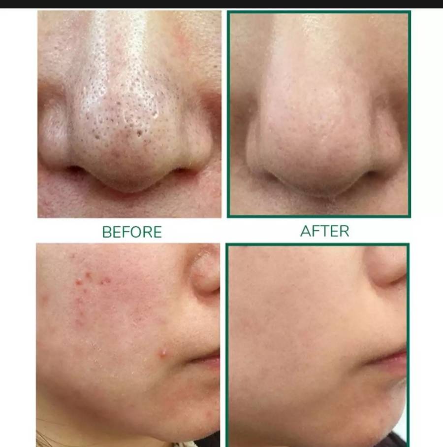 Orderme_plz's tweet image. SOME BY MI : BYE BYE BLACKHEAD 30วัน  ปริมาณ120มล
คลีนเซอร์บำรุงผิวหน้า ช่วยลดเลือนริ้วรอย ลดรอยสิวต่างๆ ด้วยการมาร์กเพียงไม่กี่นาที ทำความสะอาดรูขุมขนอย่างหมดจด พร้อมทั้งขจัดสิวหัวดำในขั้นตอนเดียว
#พร้อมส่ง #somebymi #ByebyeBlackheads #เครื่องสําอางเกาหลี
ราคา 590฿ รวมส่ง ลทบ