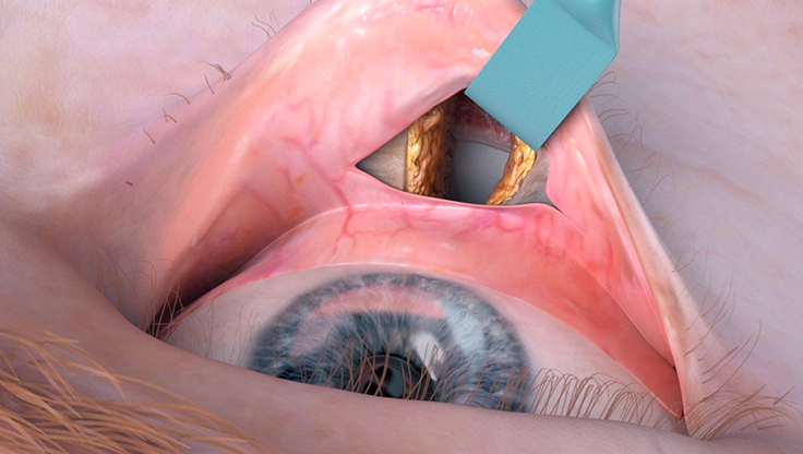 sciencestanding's tweet image. #3DOculoplastyProcedures 3D Facial Procedures features 3D animations that enable users to see the pearls of procedures from didactic perspectives and demonstrate fundamental knowledge of anatomy while learning complex periocular surgery.

Get the app: bit.ly/2FxcpHg