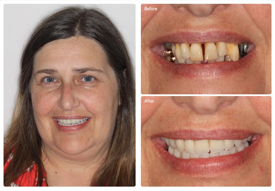 All-on-Four Dental Implants from £11,500 - find out if they could be suitable for you clinics.dental/implant5
#MissingTeeth #DentalImplants