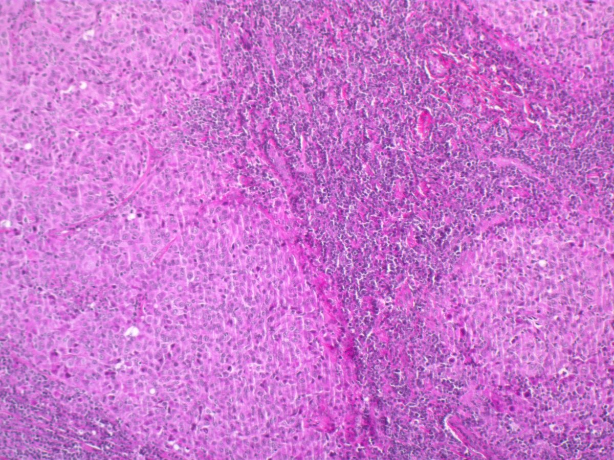 Tenonhospital's tweet photo. Metastatic lymphnode in parotis, history of breast cancer, you believe in this?? 
Which AB would you try? https://t.co/mBWb6xLvCM
