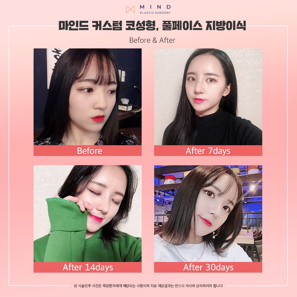 mindprs's tweet photo. 수술부위
[코성형 &amp; 지방이식풀페이스] 리얼스토리

더 많은 사진을 보고 싶다면
지금 홈페이지에 로그인 해주세요!
▶ 홈페이지 : https://t.co/HB2wCmHdLo  
▶ 카카오톡 :mindprs
▶ 전화번호 : 02.542.1006

#마인드성형외과 #성형외과 #서울성형외과 #신논현역성형외과 https://t.co/ccDsF2r73C